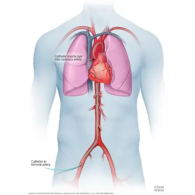 Coronary Angiography​