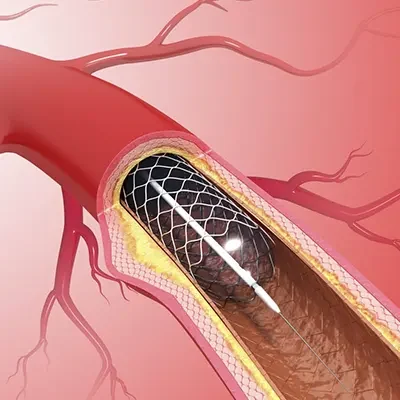 Coronary Angioplasty