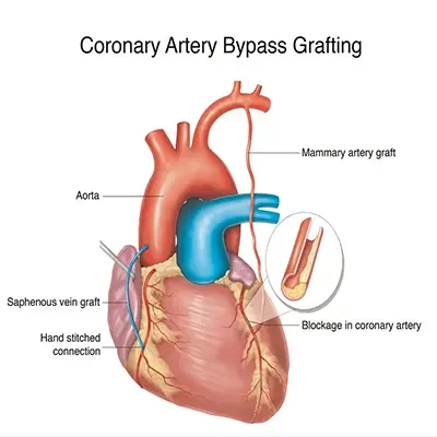Coronary Artery Bypass