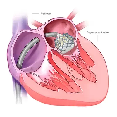 Heart Valve Replacement